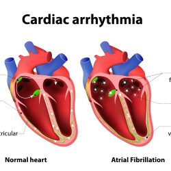 Hesi case studies heart failure with atrial fibrillation