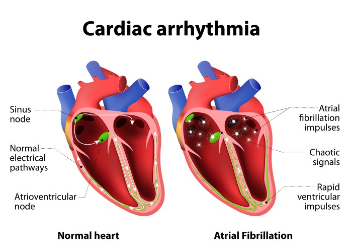 Hesi case studies heart failure with atrial fibrillation